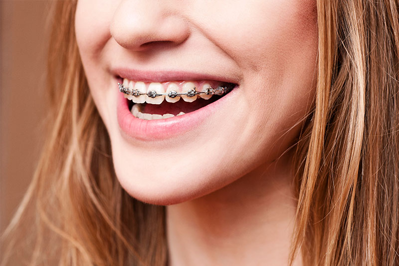 Orthodontics in Pasadena