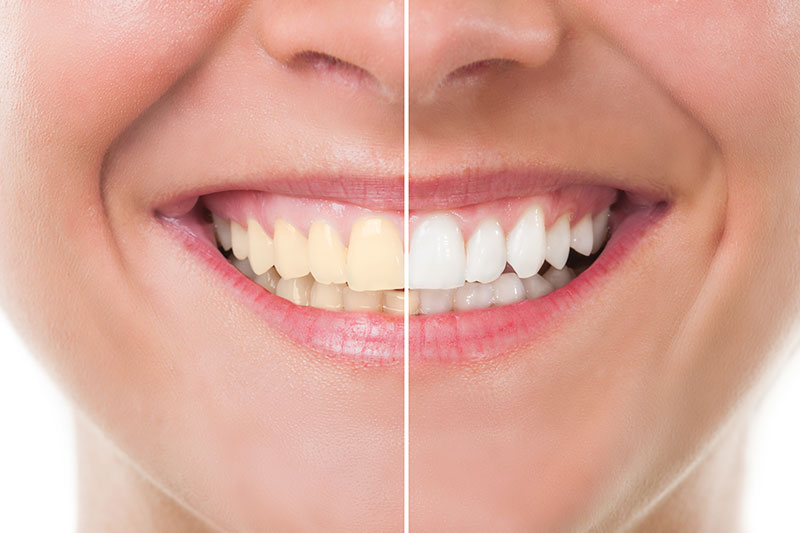 Teeth Whitening in Pasadena